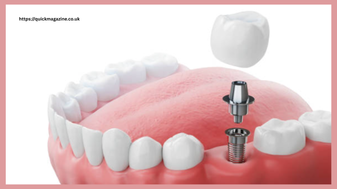 Dental Implants